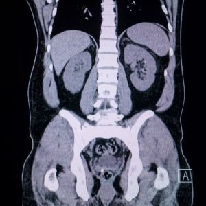Chest CT Scan