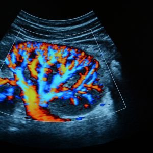Venous Doppler