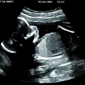 Ultrasound