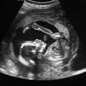 Obstetric Ultrasound (TVS)